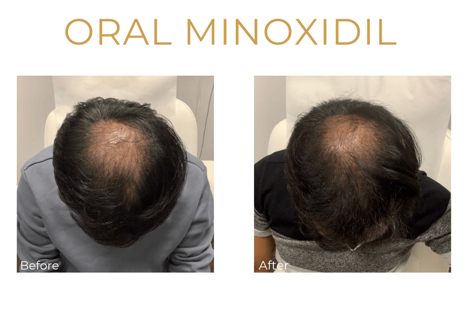 Before & After Retinol